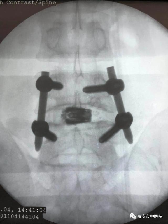 腰腿痛患者的福音——海安市中医院成功开展椎间孔镜下腰椎椎间植骨融合术 图1