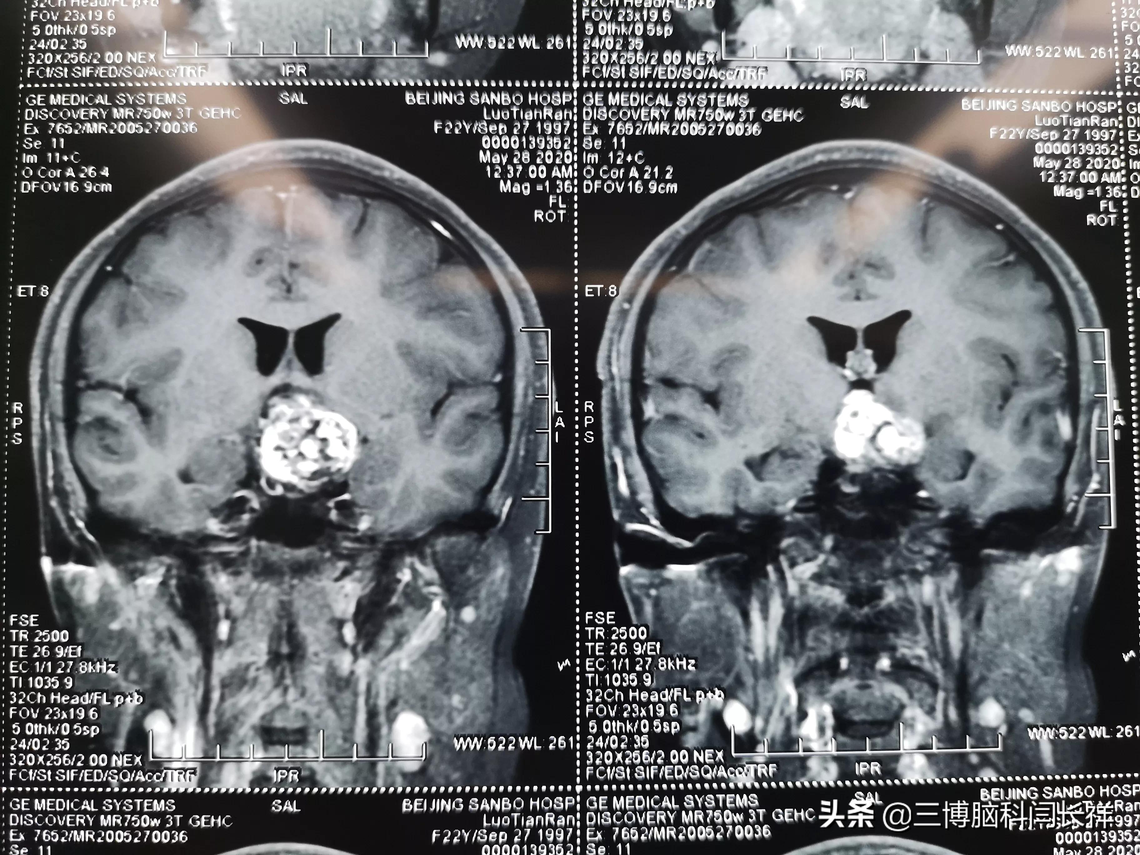 脑瘤是什么样子图片图片