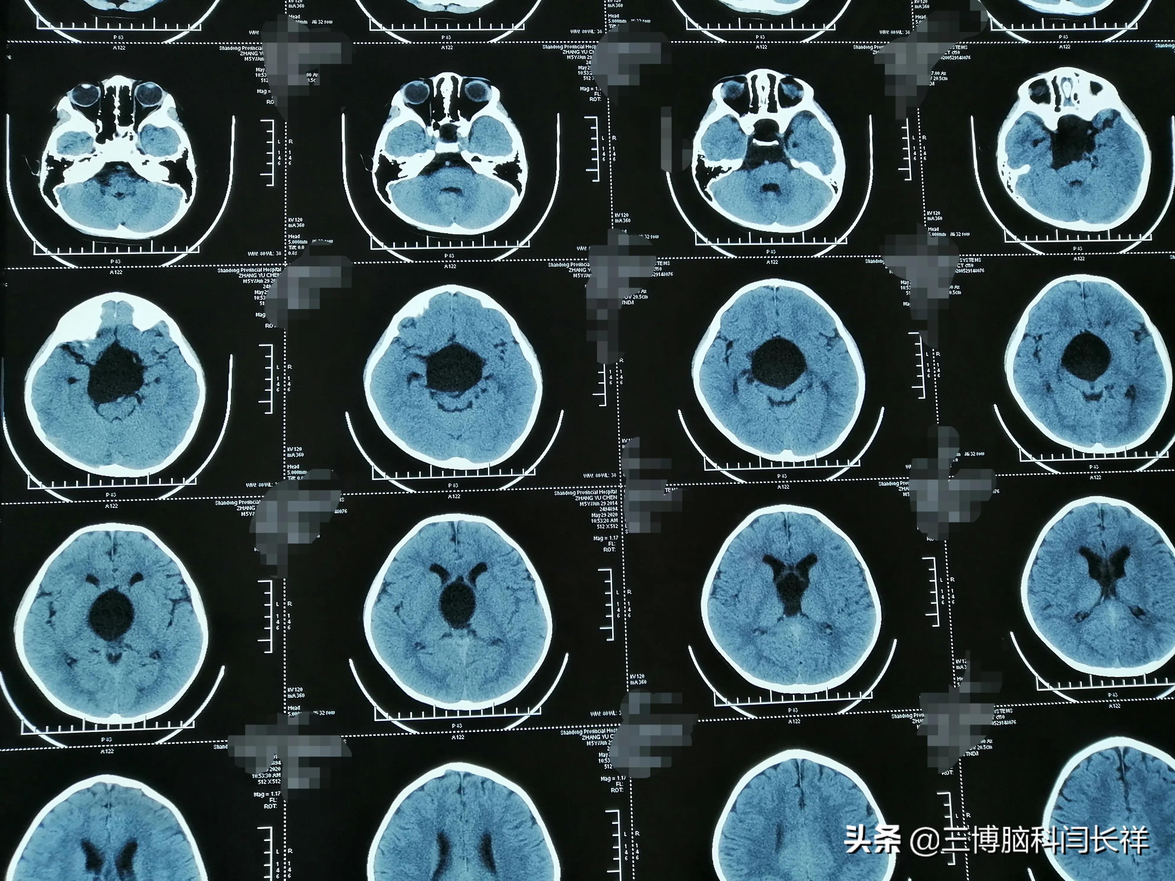 容易引起误诊的症状——食积_蛛网膜囊肿_蛛网膜囊肿症状表现 - 好