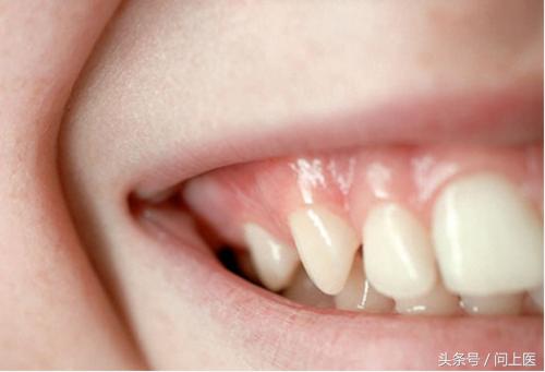 健康的牙龈