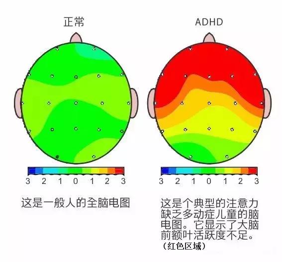 脑电地形图,能准确无误的观测孩子脑内神经系统的活动情况.