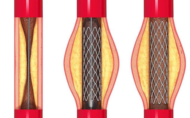 心脏支架可以用多少年?听听医生怎么说!