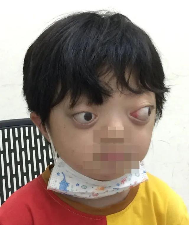 crouzon 综合征女患儿诊治记录_下颌整形 - 好大夫在线