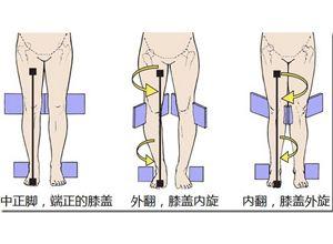 儿童膝内翻与膝外翻需要矫正么?