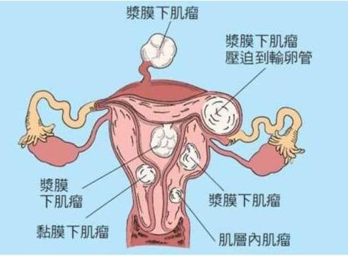 分为子宫肌壁间肌瘤,子宫浆膜下肌瘤,子宫黏膜下肌瘤,形成肌瘤之后