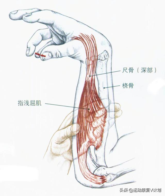 手指屈肌腱分区图片图片