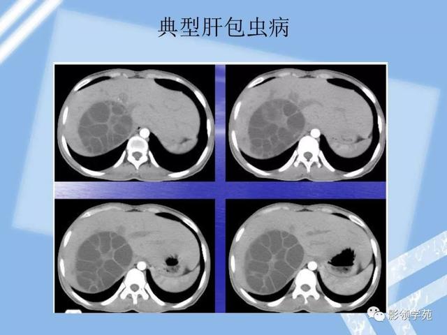 5,肝包蟲病4,腎細胞癌肝轉移腫瘤膨脹性生長,可有包膜,易出血,壞死,囊