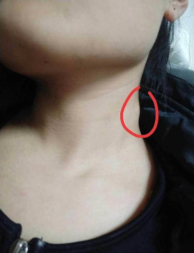 颈子淋巴痛的症状及缓减治疗方法_健康症状网