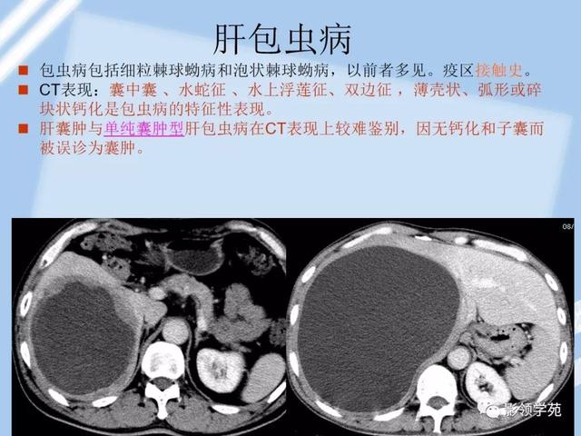 5,肝包蟲病4,腎細胞癌肝轉移腫瘤膨脹性生長,可有包膜,易出血,壞死,囊