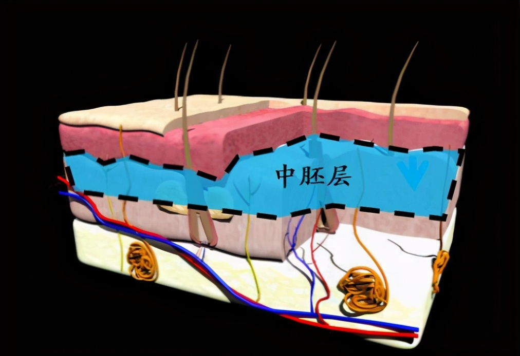 中胚层治疗脱发.