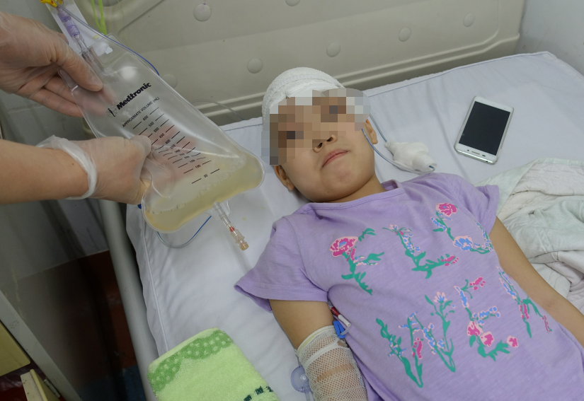 颅脑外伤后脑脊液鼻漏4年余内:先后在3家医院历经8次住院,3次脑脊液漏