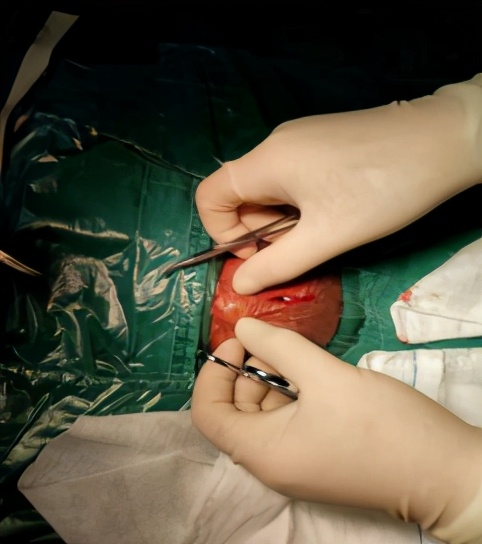 微创ommaya囊治疗新生儿脑积水广西妇幼保健院罗树友副主任医师为