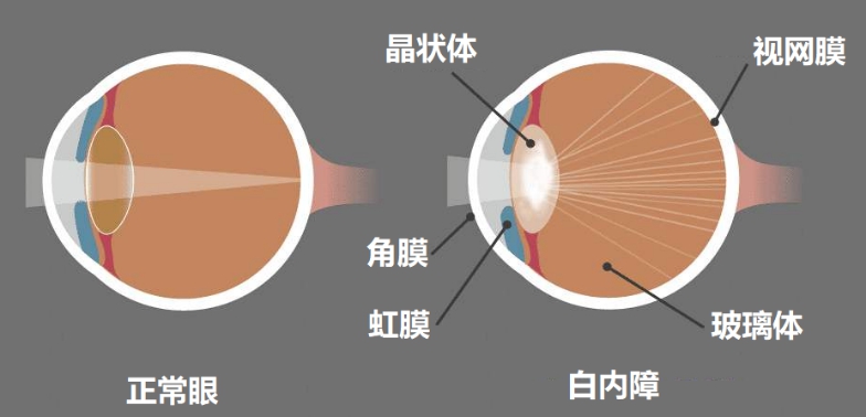 視力下降可能不是近視還有可能是白內障